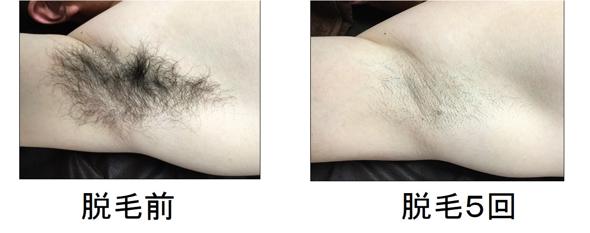 鼻下脱毛 5回目 24歳