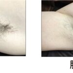 ★あごヒゲ脱毛 5回目