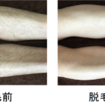 ★ 鼻下・あご髭脱毛 9回目