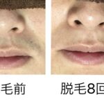 ★鼻下脱毛 8回目
