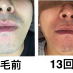 ★鼻下あごヒゲ脱毛 13回目