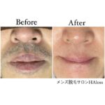 ★ヒゲ脱毛症例