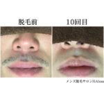 ★ヒゲ脱毛 10回目