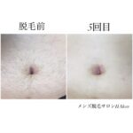 ★お腹脱毛 5回目