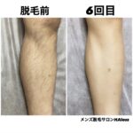 ★脚脱毛 6回目